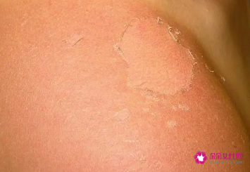 晒伤发痒擦什么止痒