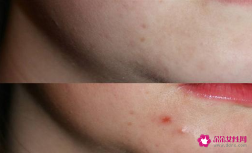 脸部毛孔堵塞怎么清理