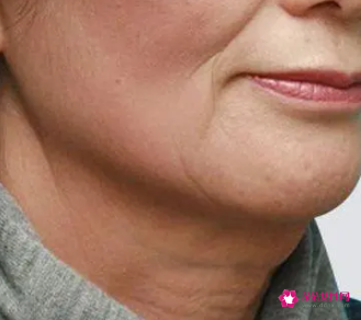 去除皱纹的最好的办法