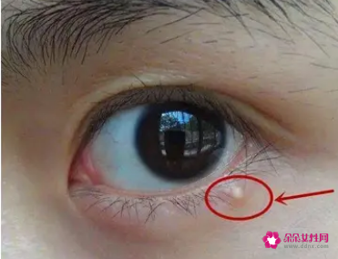 如何祛除眼部脂肪粒