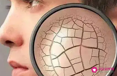 脸上干燥起皮刺痛怎么办