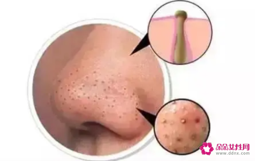 脸部毛孔堵塞怎么清理