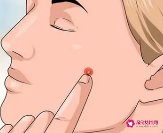 青春期脸上长痘痘怎么调理排毒祛痘