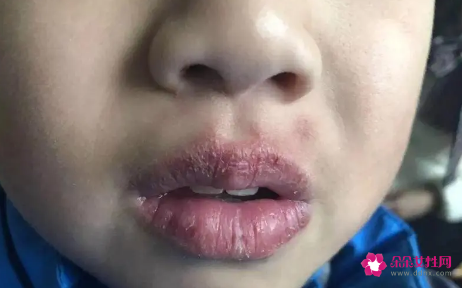 小孩子嘴唇红该怎么办