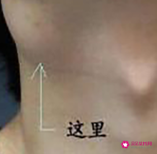 颈部淋巴结肿大症状图