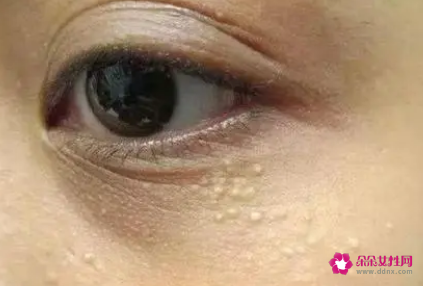 如何祛除眼部脂肪粒