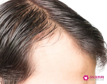 发际线高不想剪刘海