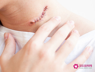 颈部淋巴结肿大症状图