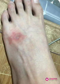 梦到脚上长了好多小疙瘩