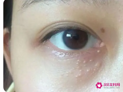 如何祛除眼部脂肪粒