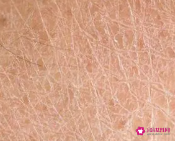 皮肤干燥缺水会出现哪些问题