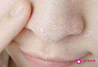 用什么洗脸可以去黑头