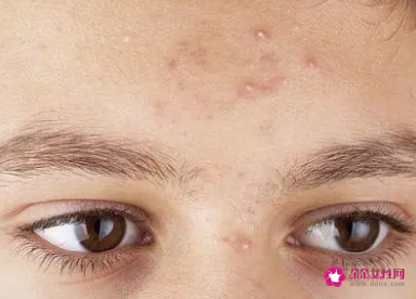 青春期脸上长痘痘怎么调理排毒祛痘