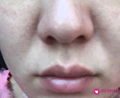 脸部皮肤松垮垮的怎么办