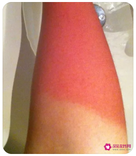 晒伤发痒擦什么止痒