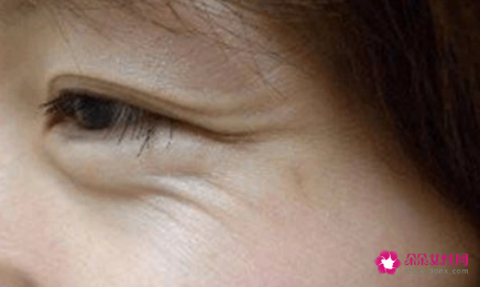 女人脸部长皱纹该怎么办