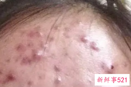 干燥冬季如何战痘