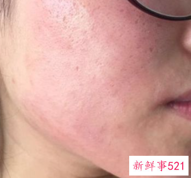 脸上敏感发红怎么办