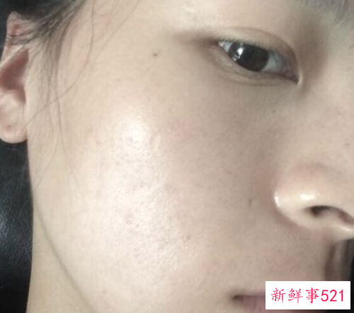 美白淡痘印最简单的方法