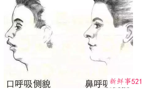 用嘴呼吸为什么会变丑