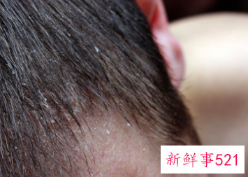 头上脸上油脂分泌过多的原因