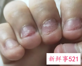十几岁孩子咬指甲什么原因