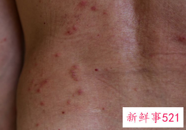 过敏体质怎么治疗最好方法