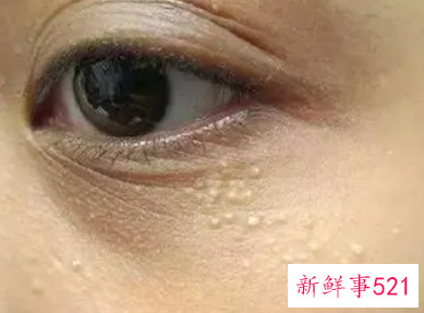 脸上长脂肪粒怎么去除小窍门