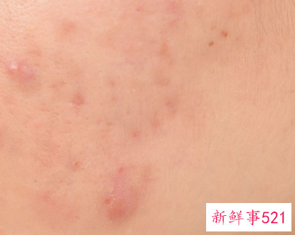 毛孔粗大最有效果的医美