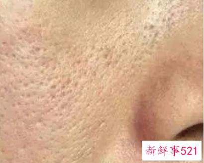 毛孔粗大最有效果的医美