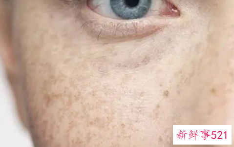黄褐斑怎样祛除