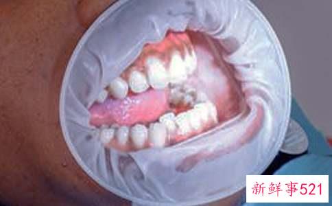 儿童刷牙时牙龈出血是怎么回事