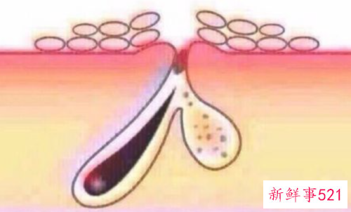 美白淡痘印最简单的方法