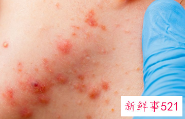 过敏体质怎么治疗最好方法