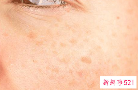 黄褐斑怎样祛除