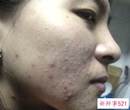 美白淡痘印最简单的方法