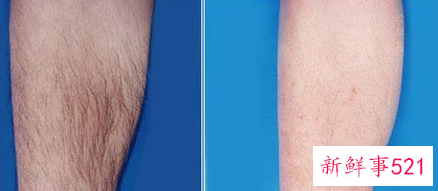 如何有效去腿毛呢