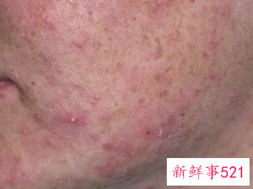 脸上很干起皮补水很痛