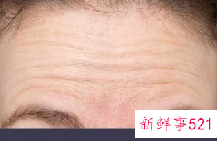 额头静态皱纹怎么处理