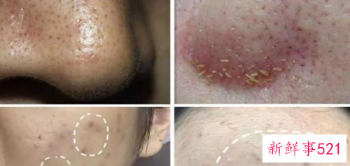 螨虫和痘痘有什么关系