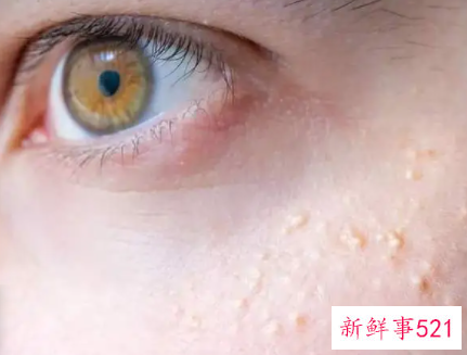 怎样才能消除脂肪粒