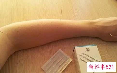 针灸的好处有什么