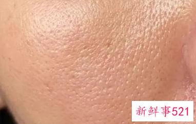 怎么改善皮肤毛孔粗大,泛红
