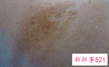 黑色素沉着会自己淡化吗