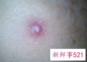 男性刚得了梅毒的照片