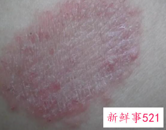 如何辨别皮肤是不是癣