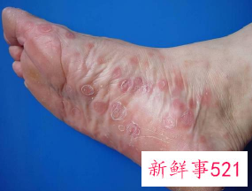 男性刚得了梅毒的照片