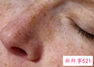 祛雀斑最好的方法