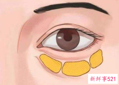 眼袋怎么快速消除