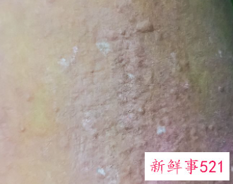 如何辨别皮肤是不是癣